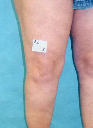 Legs after spider vein laser removal treatment - front view