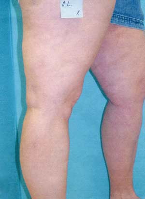 Legs after spider vein laser removal treatment - side view