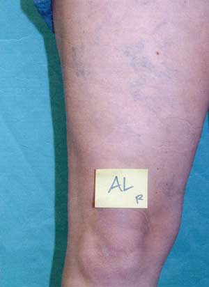 Legs with spider veins - front view