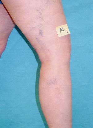 Legs with spider veins - side view